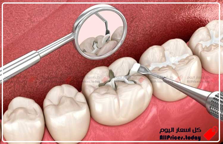 سعر حشوة الأسنان الدائمة - كل ما تحتاج معرفته